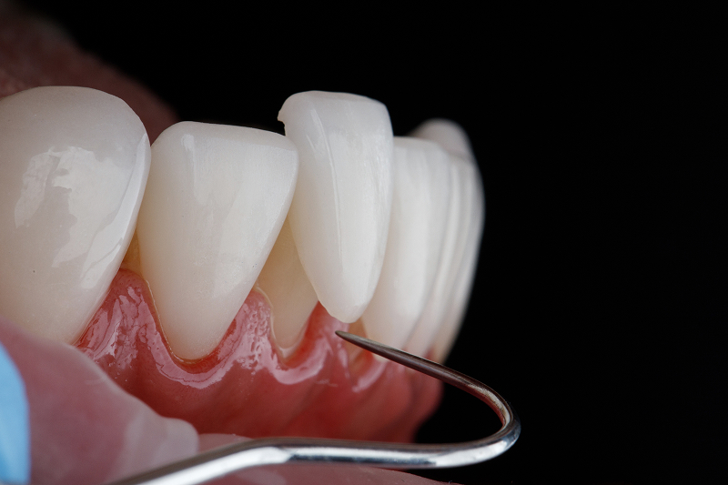 Licówka pełnoceramiczna: czym jest, ile kosztuje oraz kiedy warto ją założyć