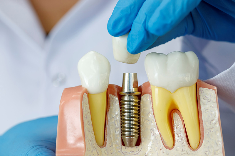 Implant czy most – co wybrać w 2026 roku?