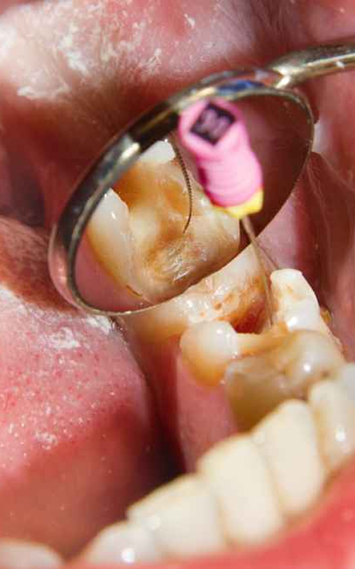 Endodontyczne leczenie kanałowe zęba trzonowego pod mikroskopem w gabinecie stomatologicznym Dentallo Warszawa Bielany
