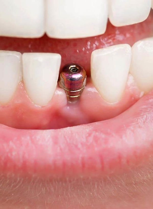Widoczny implant zębowy w odcinku przednim żuchwy przygotowany do osadzenia korony protetycznej