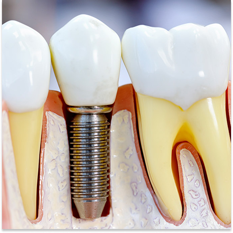 Przekrój implantu dentystycznego z osadzoną koroną protetyczną pomiędzy naturalnymi zębami.