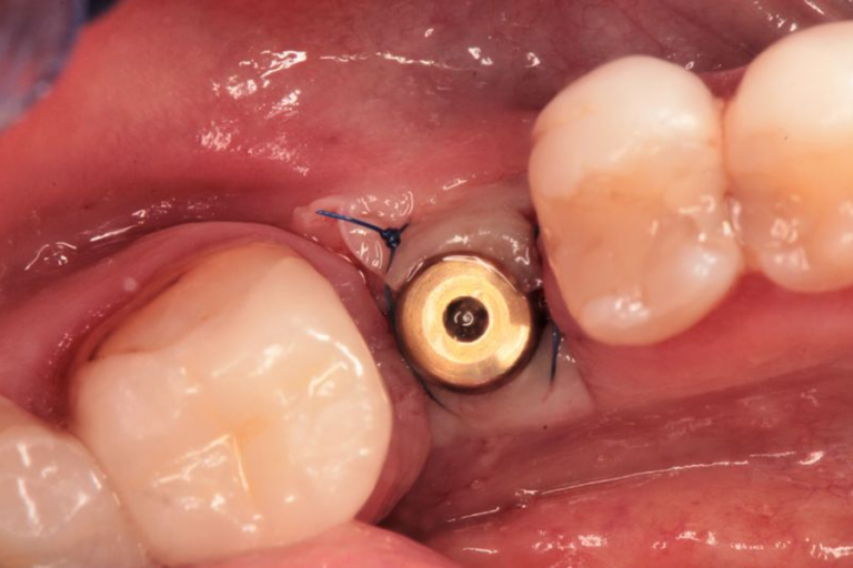 Implant dentystyczny po wszczepieniu z widocznymi szwami chirurgicznymi podczas procesu gojenia tkanek.