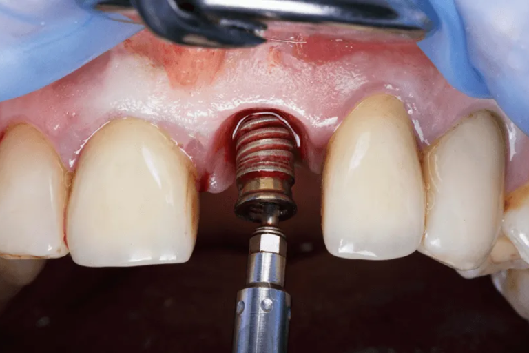 Wszczepianie implantu dentystycznego w miejsce brakującego przedniego zęba podczas zabiegu implantologicznego.