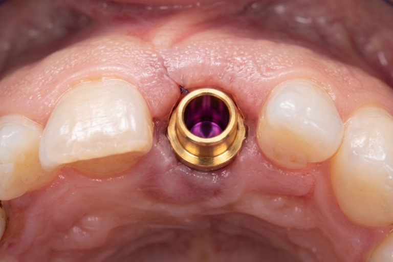 Łącznik gojący implantu dentystycznego zamocowany w miejscu brakującego przedniego zęba