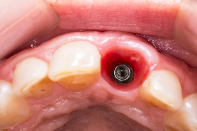 Odsłonięty implant dentystyczny w miejscu brakującego zęba podczas etapu gojenia po implantacji.