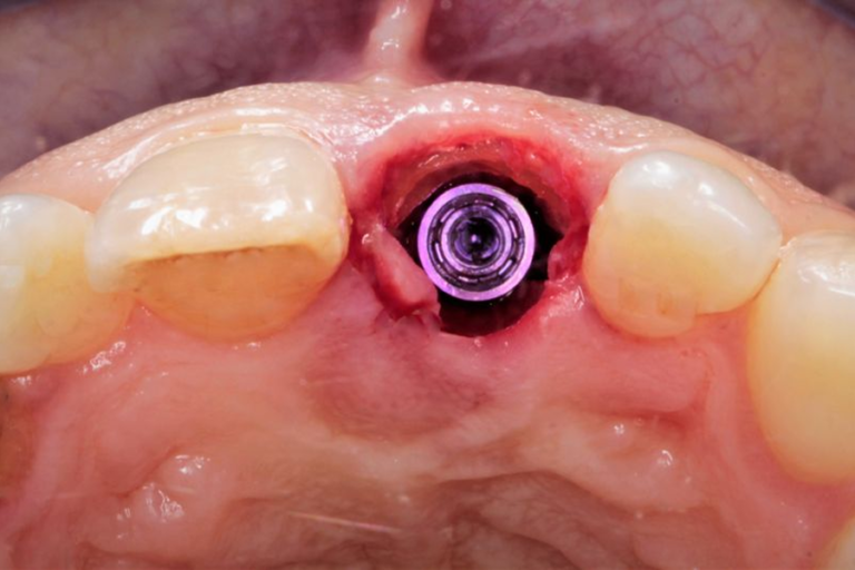 Widok implantu dentystycznego w trakcie leczenia implantologicznego po odsłonięciu w miejscu brakującego zęba.