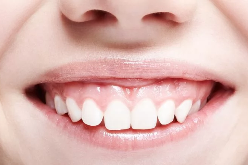 Gummy smile – czy można zmniejszyć widoczność dziąseł?